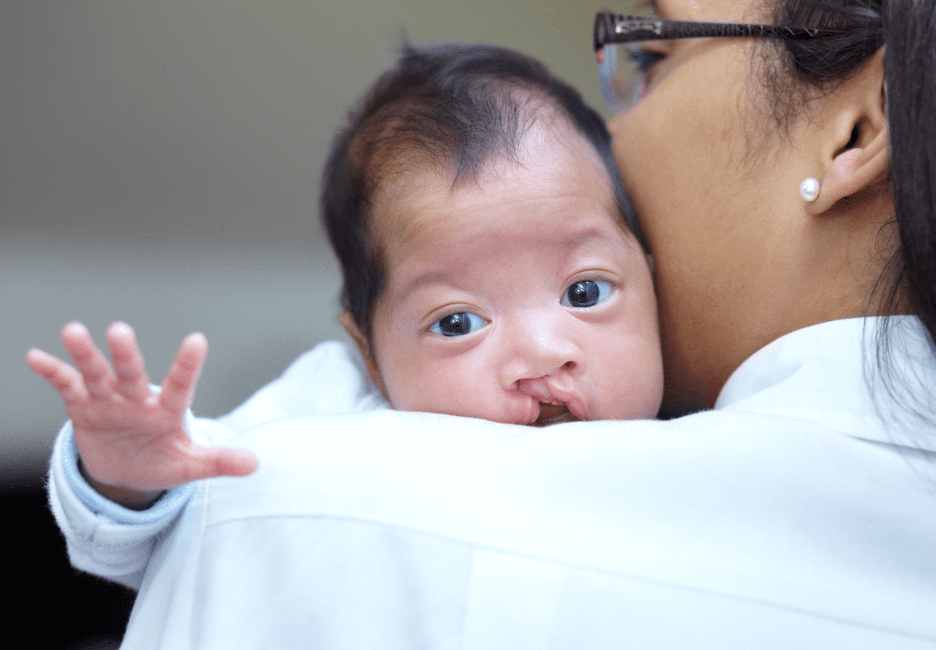 An infant with a cleft lip looks over the shoulder of a woman.